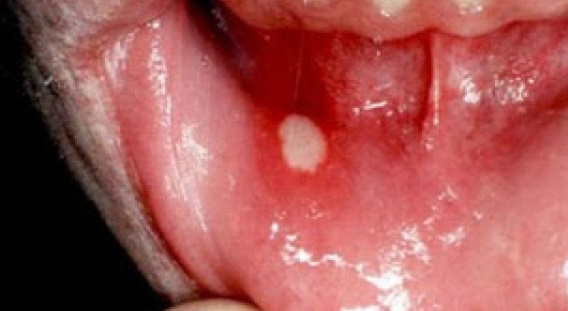 Άφθες στο στόµα: Αιτίες & θεραπεία